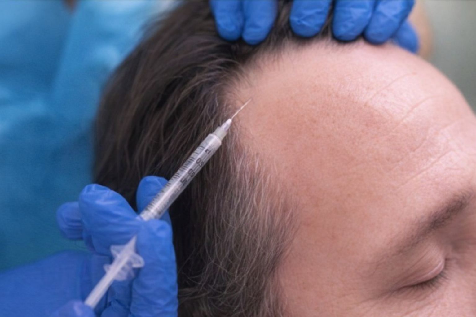 En person modtager en PRP-behandling i hovedbunden mod hårtab.